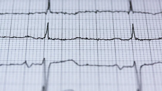 Electrocardiograma Electrocardiograma
