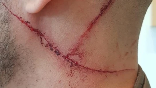 Las heridas provocadas por el hombre al policía tras mantener una discusión Las heridas provocadas por el hombre al policía tras mantener una discusión