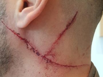 Las heridas provocadas por el hombre al policía tras mantener una discusión Las heridas provocadas por el hombre al policía tras mantener una discusión