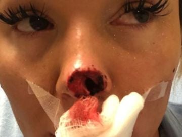 Así quedó la nariz de la joven tras la agresión recibida Así quedó la nariz de la joven tras la agresión recibida