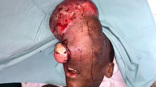 Emmanuel, el niño de 10 años con el tumor craneofacial antes de la intervención. Emmanuel, el niño de 10 años con el tumor craneofacial antes de la intervención.