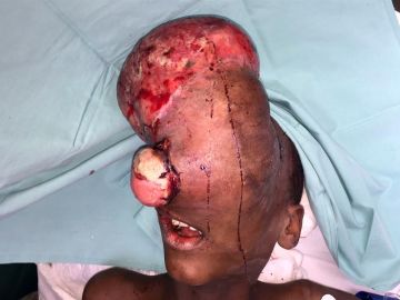 Emmanuel, el niño de 10 años con el tumor craneofacial antes de la intervención. Emmanuel, el niño de 10 años con el tumor craneofacial antes de la intervención.