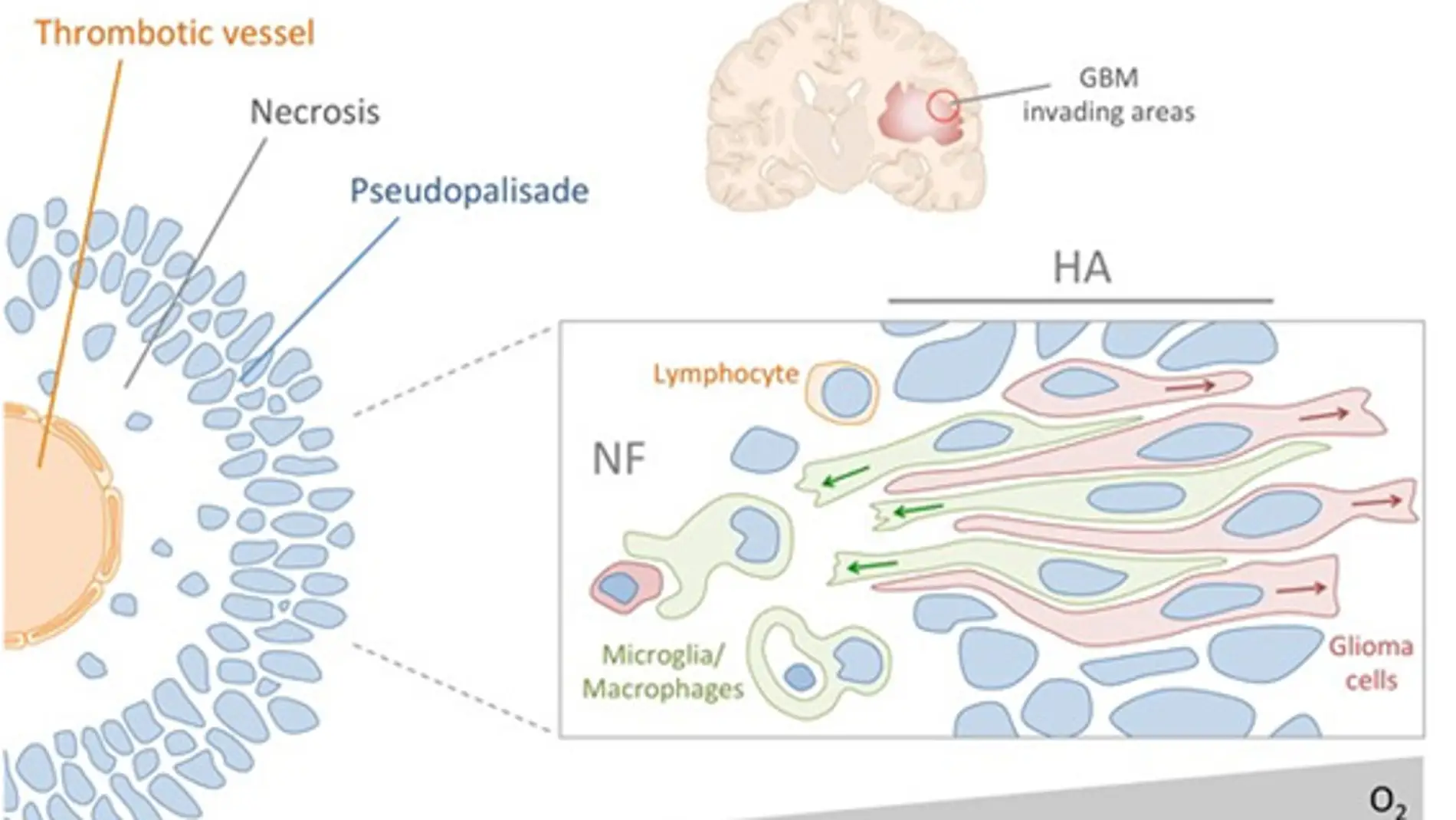 Glioblastoma