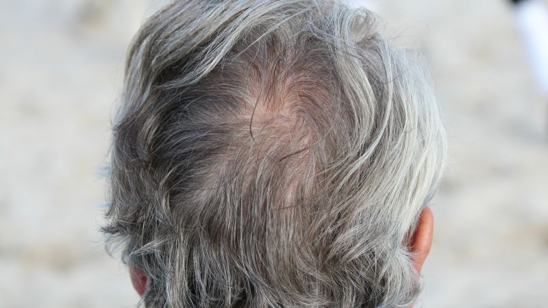 ¿Produce el estrés la aparición de canas?