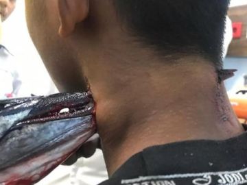 Un pez espada atraviesa el cuello de un joven Un pez espada atraviesa el cuello de un joven