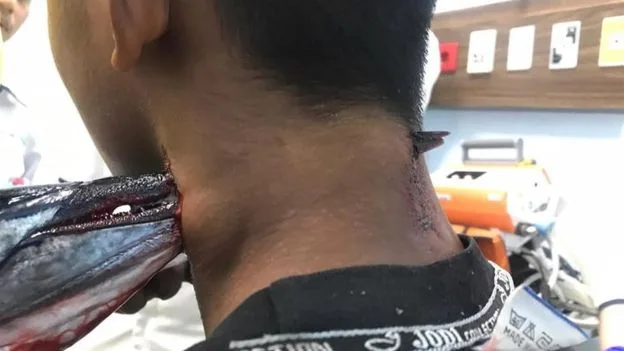 Un pez espada atraviesa el cuello de un joven