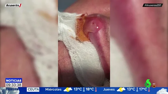 La verdad del vídeo viral sobre cómo extraen una larva gigante del labio de un hombre La verdad del vídeo viral sobre cómo extraen una larva gigante del labio de un hombre