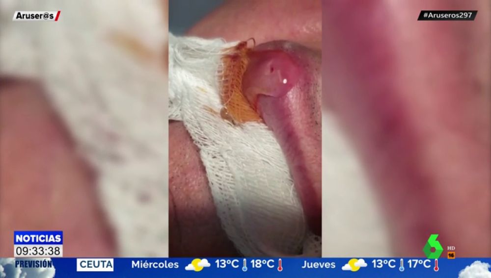larvas de mosca dentro de la piel