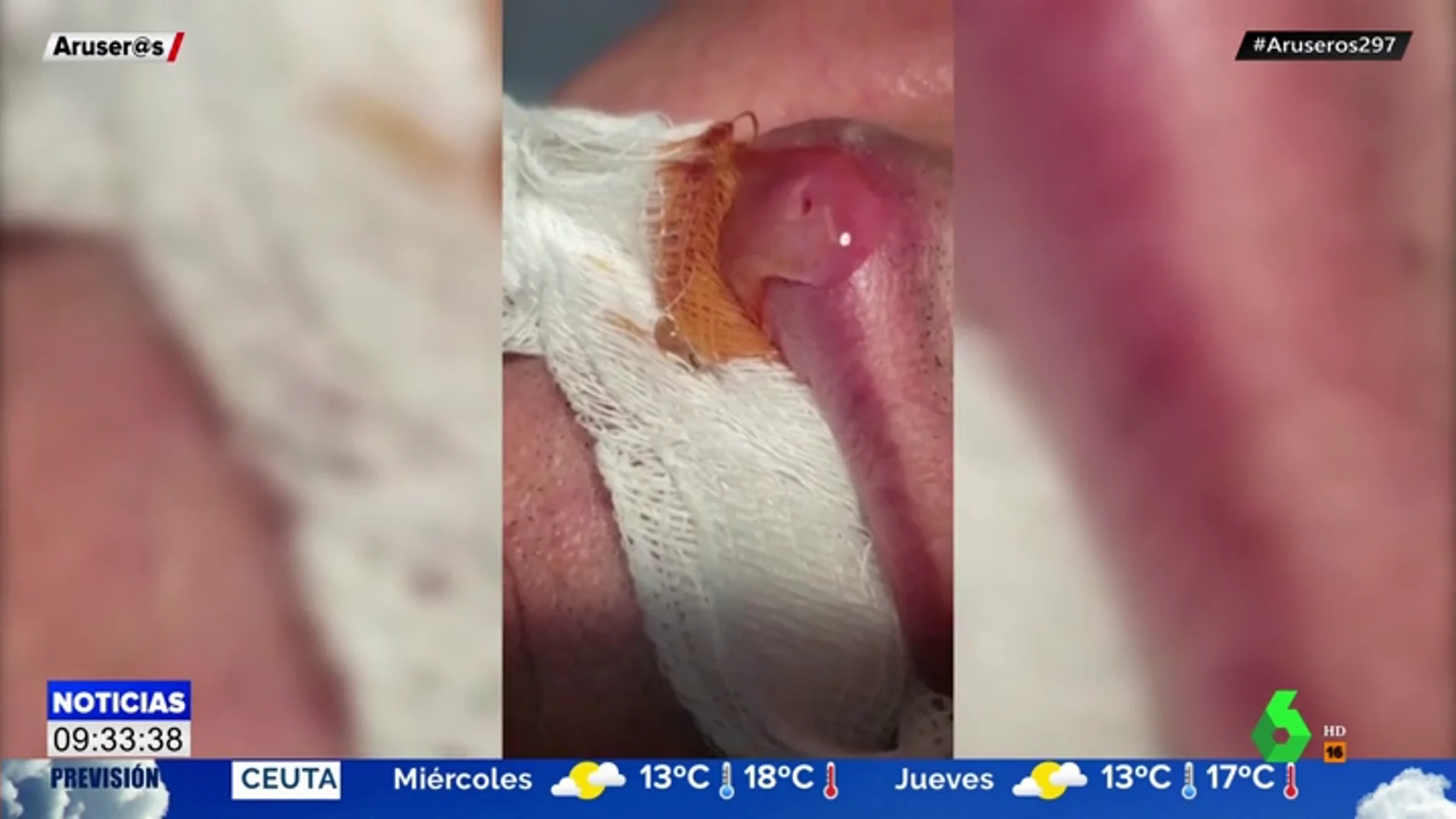 La verdad del vídeo viral sobre cómo extraen una larva gigante del labio de un hombre