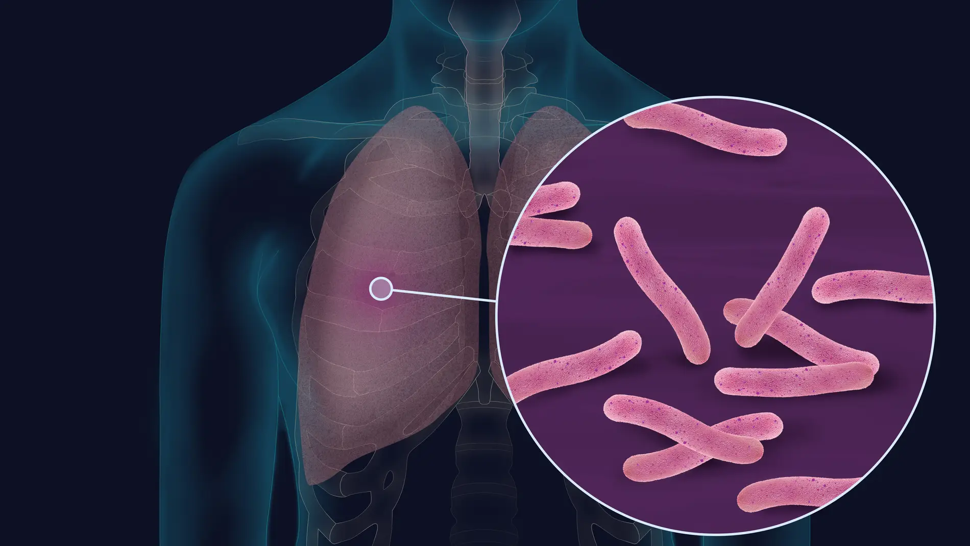 Imagen de la bacteria Mycobacterium tuberculosis