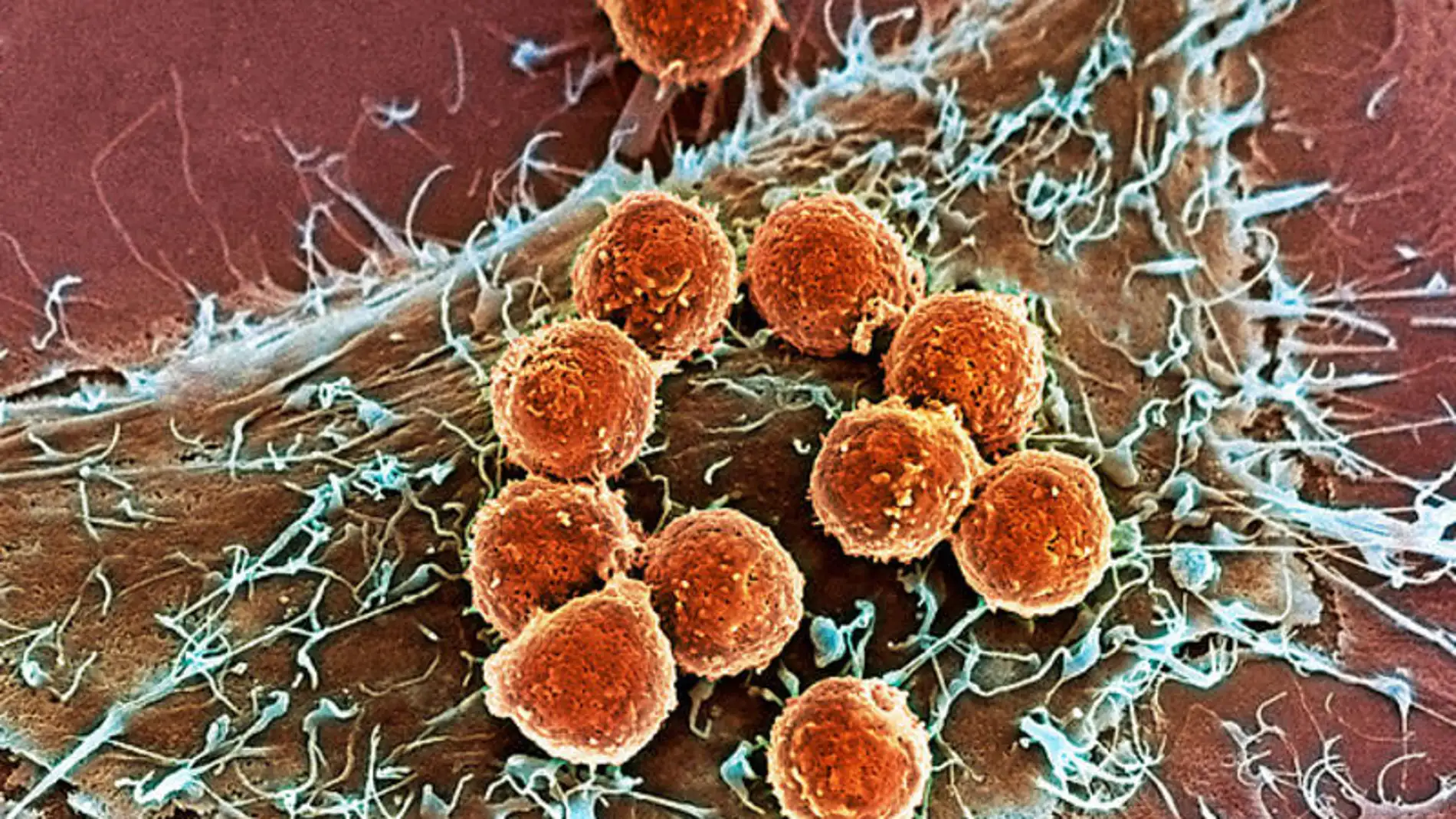Defensas editadas con CRISPR muestran su seguridad en pacientes con cancer