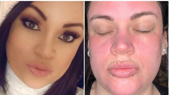 Candice antes y después de usar la crema Candice antes y después de usar la crema