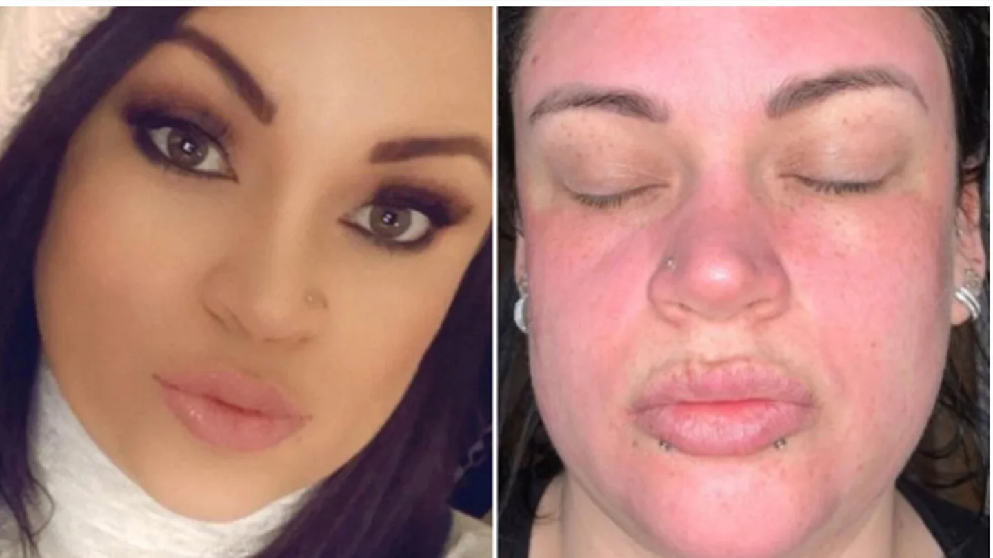 Candice antes y después de usar la crema Candice antes y después de usar la crema