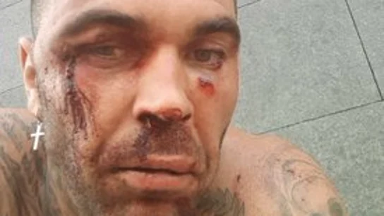 El ultra del Betis que agredió a un ciudadano bilbaíno sufre una paliza durante el carnaval de Tenerife El ultra del Betis que agredió a un ciudadano bilbaíno sufre una paliza durante el carnaval de Tenerife