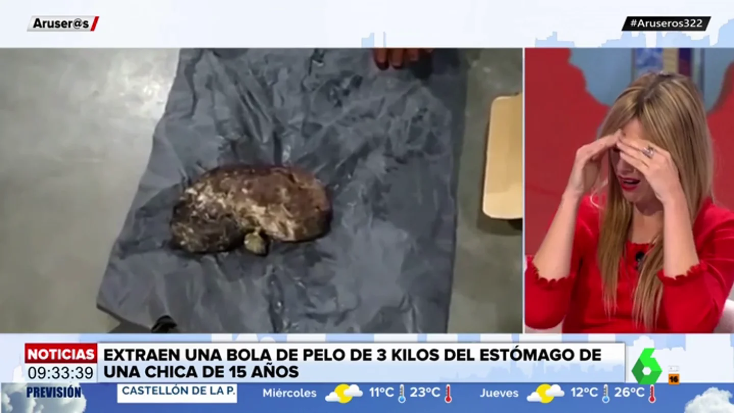Las escalofriantes imágenes de la bola de pelo de tres kilos que una chica tenía en su estómago Las escalofriantes imágenes de la bola de pelo de tres kilos que una chica tenía en su estómago