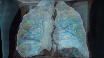 Imagen de unos pulmones afectados por coronavirus (Archivo)