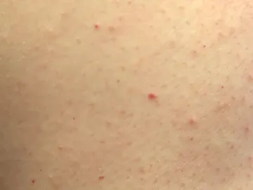 Puntos rojos en la piel Puntos rojos en la piel
