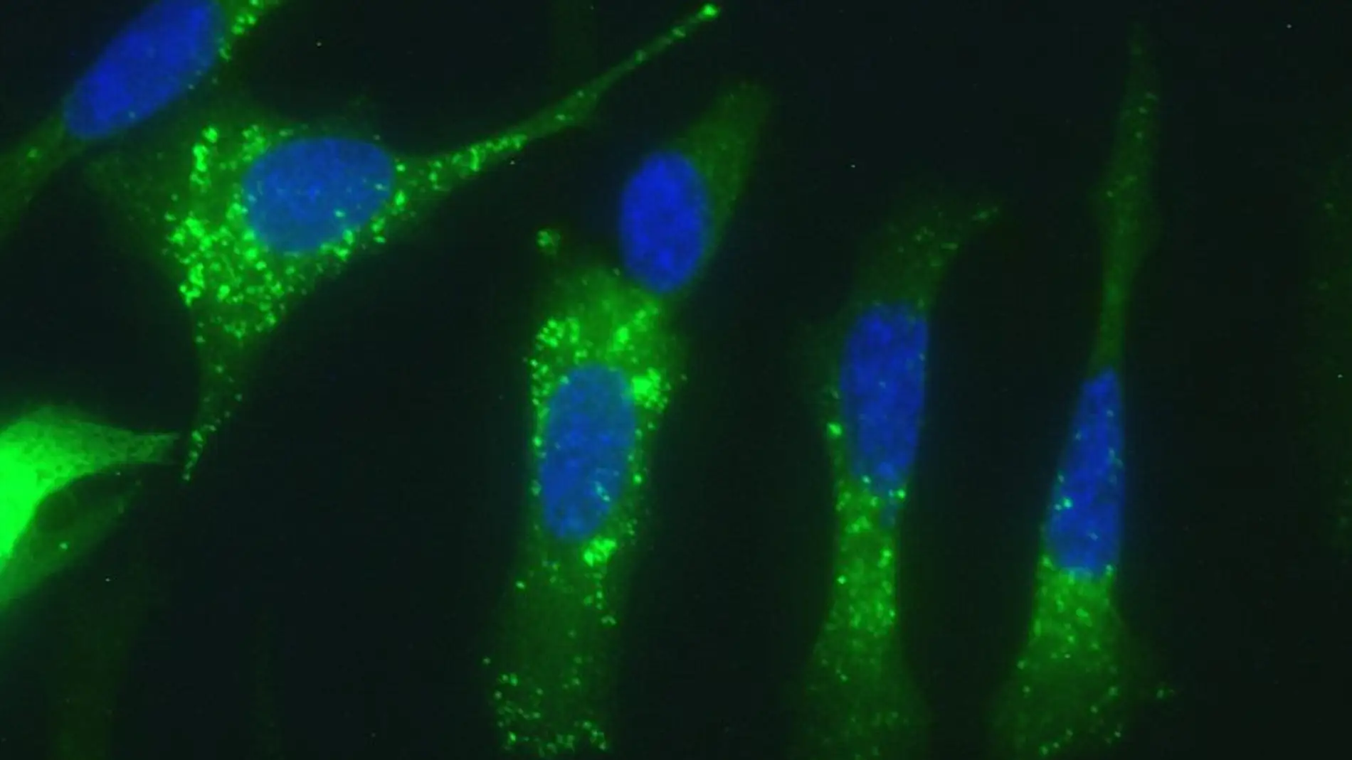 Células de adenocarcinoma pancreático humano