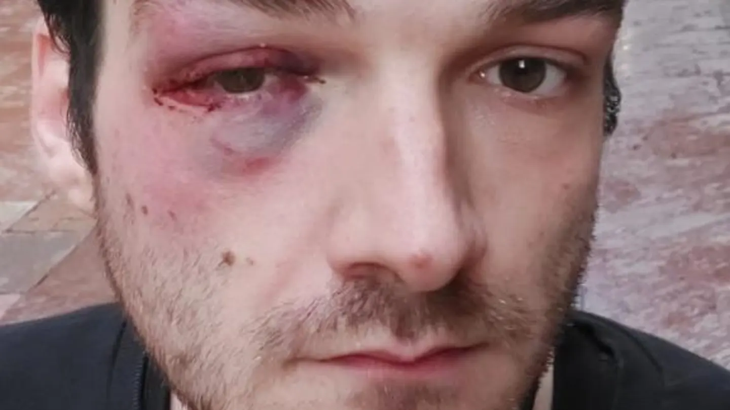 Kiko muestra su cara después de la agresión homófoba que ha sufrido en Oviedo Kiko muestra su cara después de la agresión homófoba que ha sufrido en Oviedo