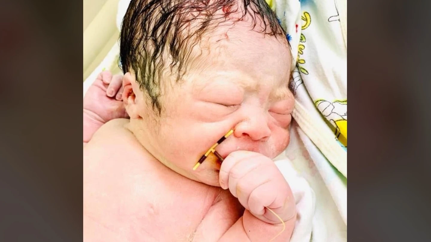 La imagen del bebé recién nacido con el DIU en la mano ha dado la vuelta al mundo La imagen del bebé recién nacido con el DIU en la mano ha dado la vuelta al mundo