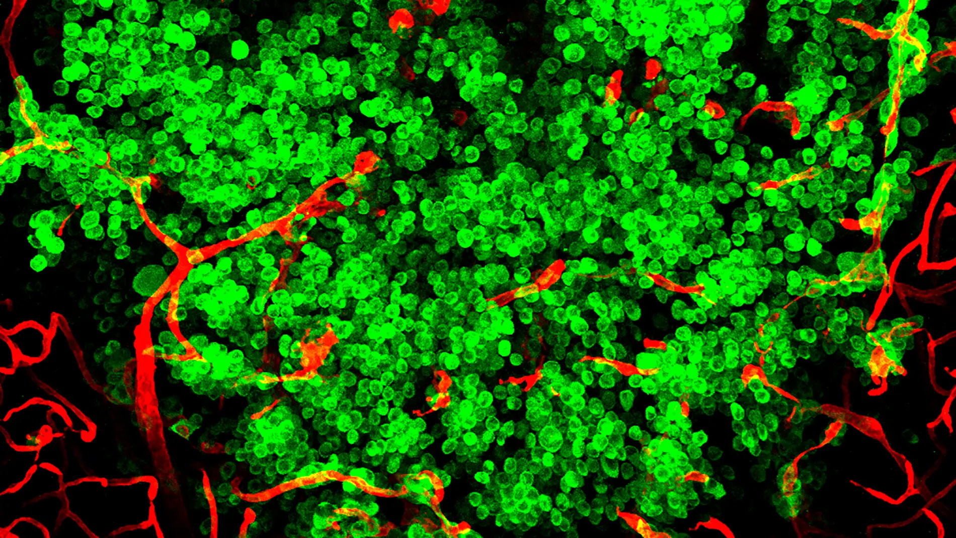 Nueva plataforma colaborativa para agilizar la investigacion en metastasis cerebral