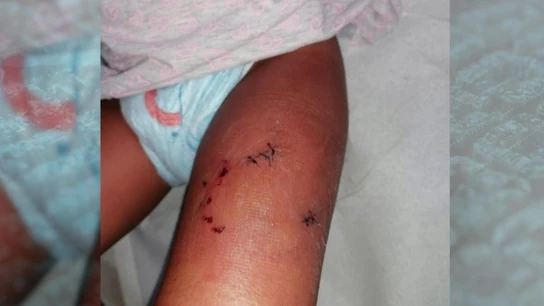 La pequeña tuvo que ser trasladada al hospital para atender las heridas provocadas por la mordedura La pequeña tuvo que ser trasladada al hospital para atender las heridas provocadas por la mordedura