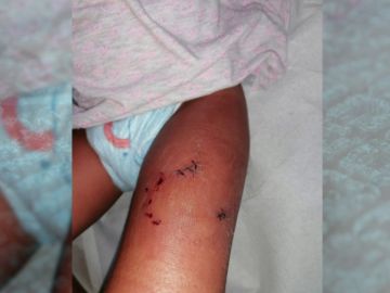 La pequeña tuvo que ser trasladada al hospital para atender las heridas provocadas por la mordedura La pequeña tuvo que ser trasladada al hospital para atender las heridas provocadas por la mordedura