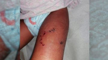 La pequeña tuvo que ser trasladada al hospital para atender las heridas provocadas por la mordedura