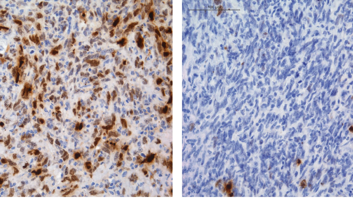 Identifican como algunos gliomas adquieren resistencia a la quimioterapia Identifican como algunos gliomas adquieren resistencia a la quimioterapia