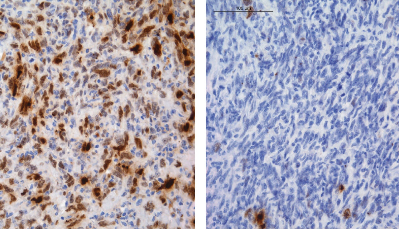 Identifican como algunos gliomas adquieren resistencia a la quimioterapia
