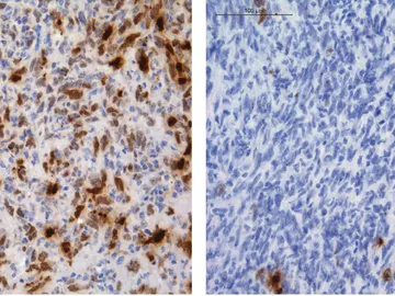 Identifican como algunos gliomas adquieren resistencia a la quimioterapia Identifican como algunos gliomas adquieren resistencia a la quimioterapia