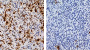 Identifican como algunos gliomas adquieren resistencia a la quimioterapia Identifican como algunos gliomas adquieren resistencia a la quimioterapia