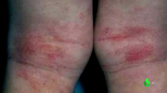 Imagen de una lesión en la piel provocada por el coronavirus Imagen de una lesión en la piel provocada por el coronavirus