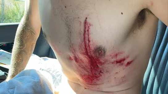 Así quedó el cuerpo de Ángel Madrazo tras su accidente Así quedó el cuerpo de Ángel Madrazo tras su accidente