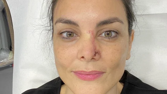 Mónica Carrillo muestra la cicatriz de su nariz tras recuperarse de un cáncer de piel Mónica Carrillo muestra la cicatriz de su nariz tras recuperarse de un cáncer de piel
