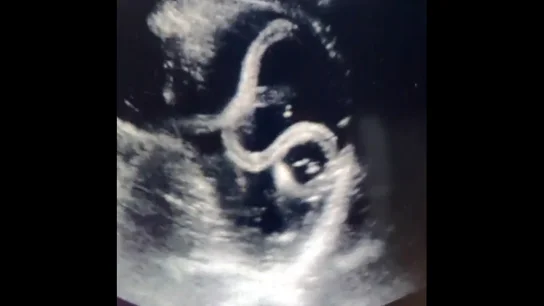 Imagen del parásito encontrado en el estómago de un ciudadano indio Imagen del parásito encontrado en el estómago de un ciudadano indio