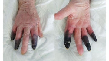 Una mujer italiana de 86 años desarrolla gangrena en los dedos por el coronavirus