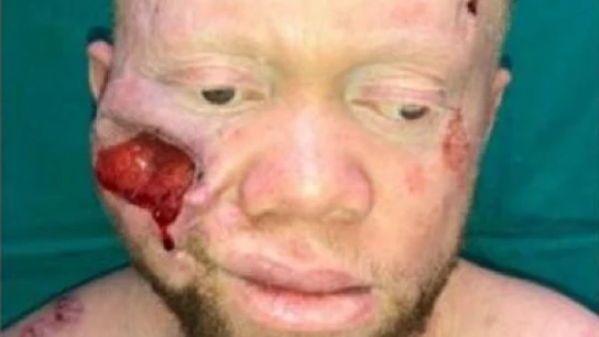 Imagen del joven intervenido de un cáncer de piel en la cara Imagen del joven intervenido de un cáncer de piel en la cara