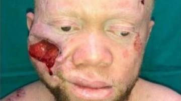 Imagen del joven intervenido de un cáncer de piel en la cara