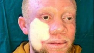 Imagen del joven intervenido de un extenso cáncer de piel en la cara