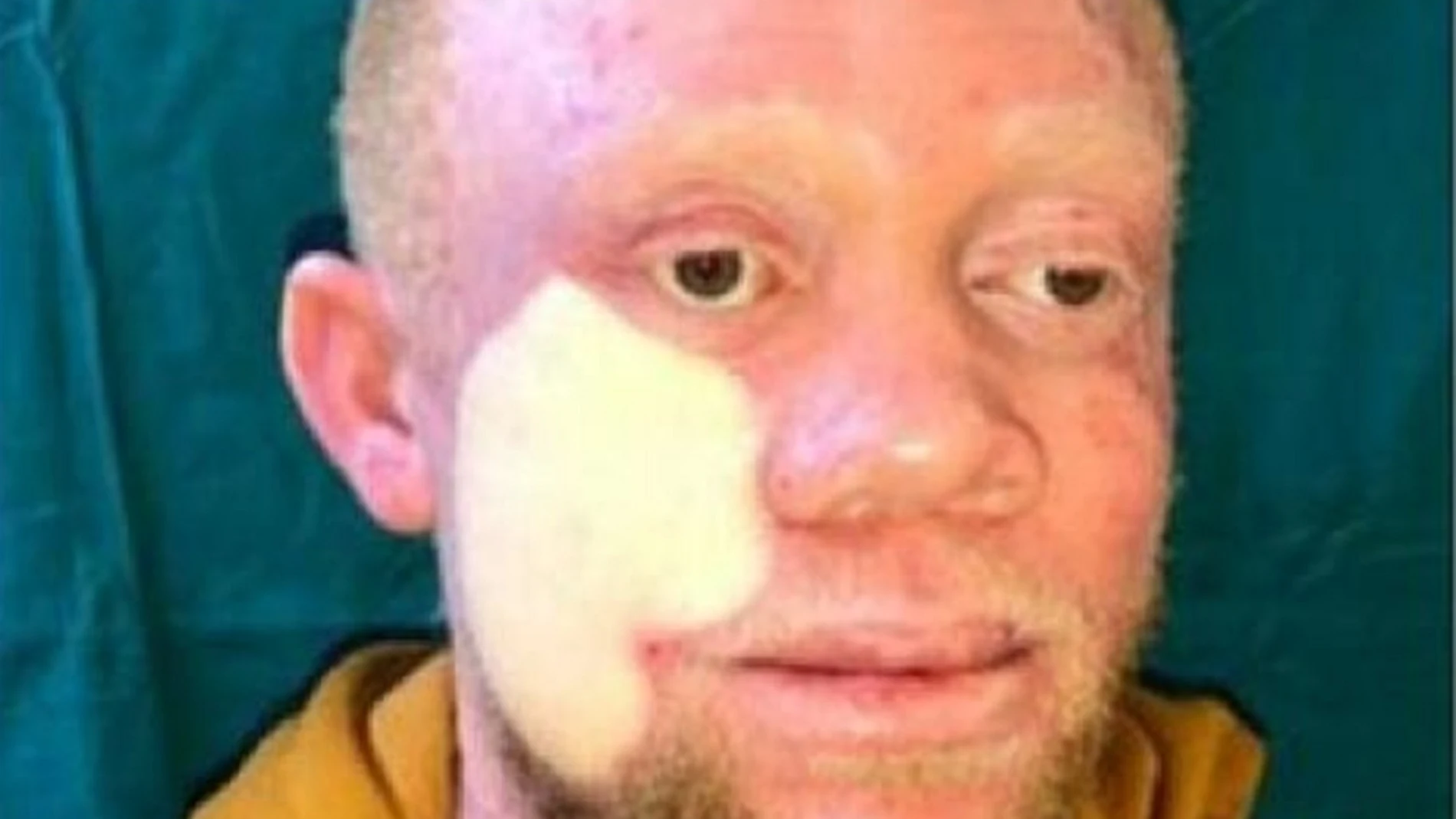 Imagen del joven intervenido de un extenso cáncer de piel en la cara