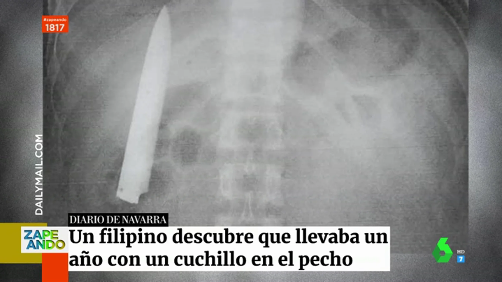 Un joven descubre con una radiografía que llevaba meses con un cuchillo en el pecho