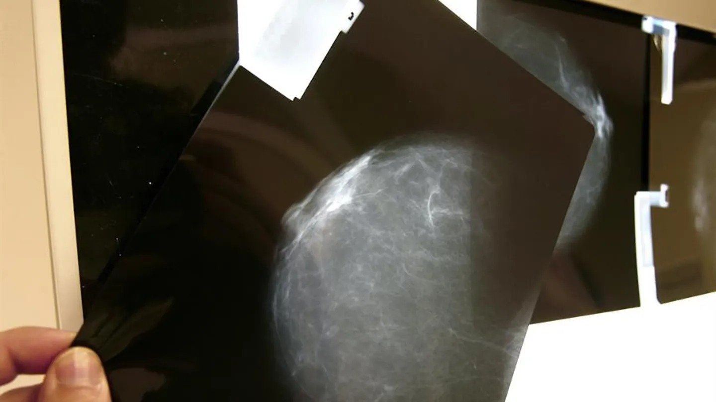 Sanidad indemnizará con 30.000 euros a una mujer por el retraso de cinco meses en el diagnóstico de un cáncer de mama Sanidad indemnizará con 30.000 euros a una mujer por el retraso de cinco meses en el diagnóstico de un cáncer de mama