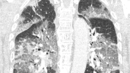 Imagen de los pulmones del paciente de Zuyderland Imagen de los pulmones del paciente de Zuyderland