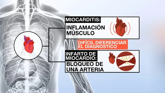 Diferencias entre una miocarditis y un infarto de miocardio Diferencias entre una miocarditis y un infarto de miocardio