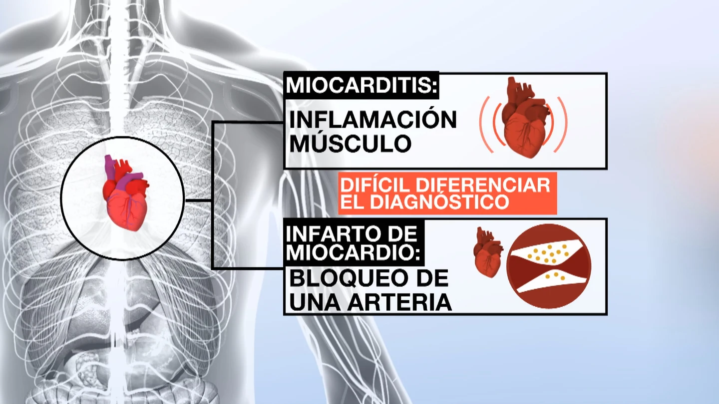 Diferencias entre una miocarditis y un infarto de miocardio Diferencias entre una miocarditis y un infarto de miocardio