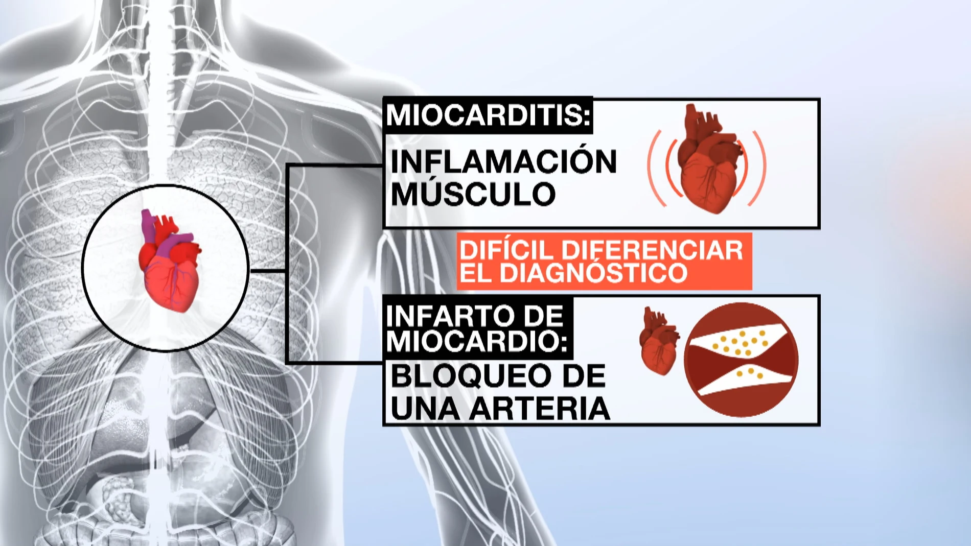 Diferencias entre una miocarditis y un infarto de miocardio