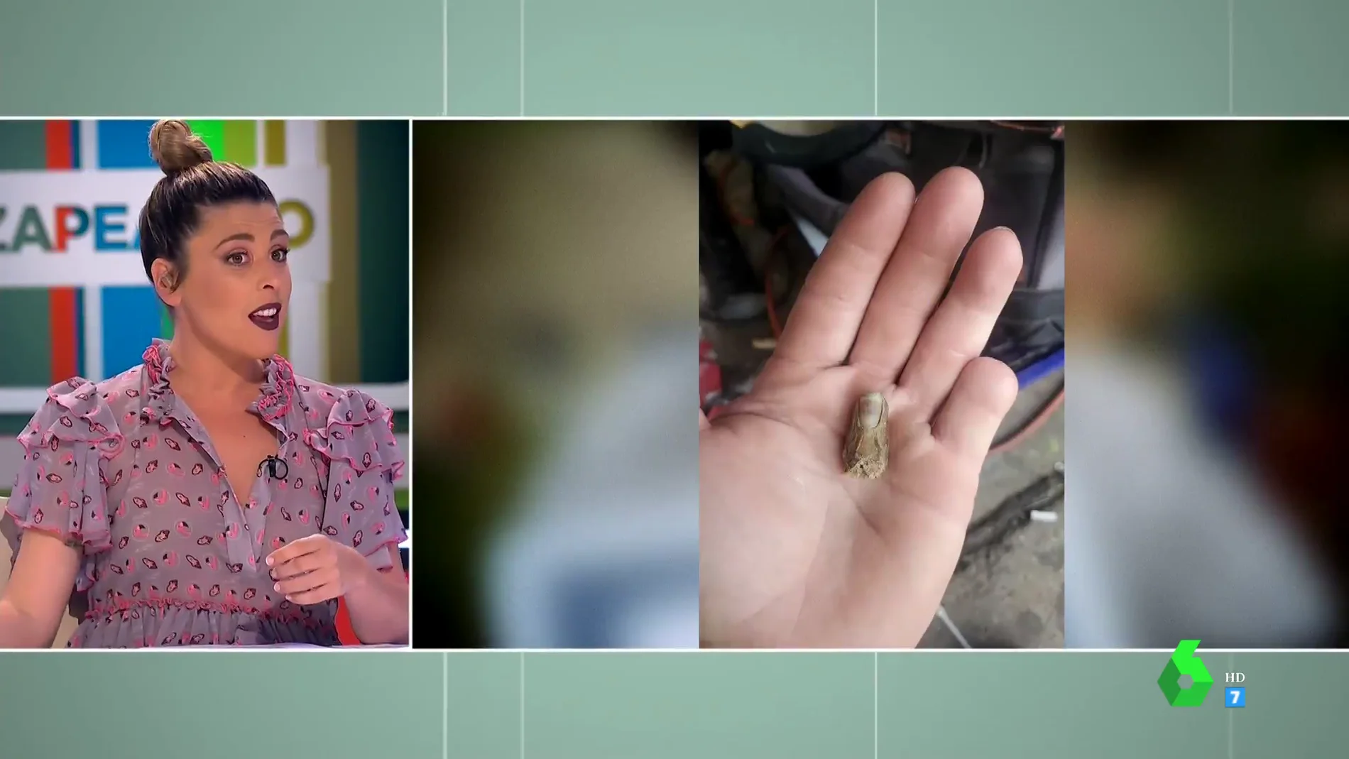 "Ya no encaja, se ha consumido": un hombre encuentra su dedo meñique seis meses después de amputárselo en un accidente