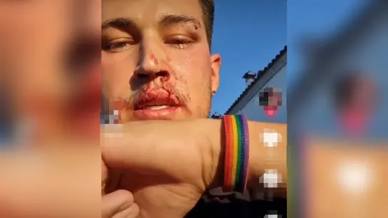 Un joven camarero denuncia a un compañero de trabajo por una brutal agresión homófoba: "Podría hasta haberme matado" Un joven camarero denuncia a un compañero de trabajo por una brutal agresión homófoba: "Podría hasta haberme matado"