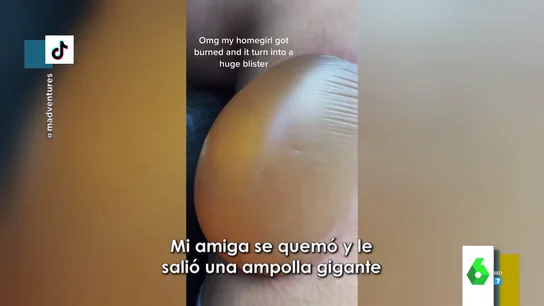 El impactante vídeo de una ampolla enorme: "Os recomiendo que cerréis los ojos" El impactante vídeo de una ampolla enorme: "Os recomiendo que cerréis los ojos"